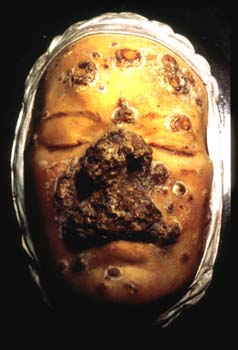 tertiary_syphilis